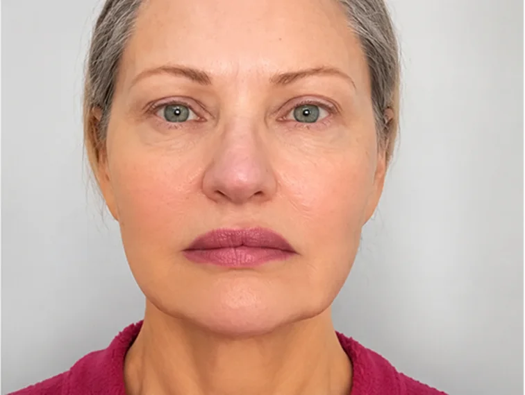 Acne and redness, after treatment