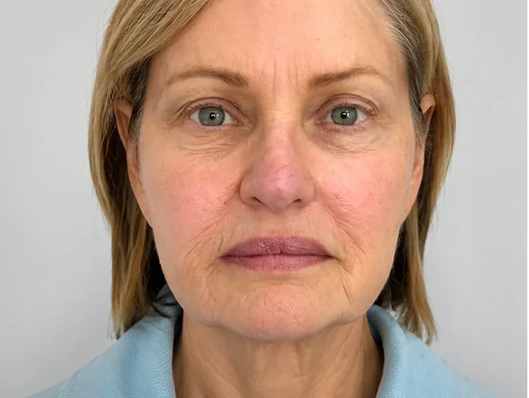 Acne and redness, before treatment