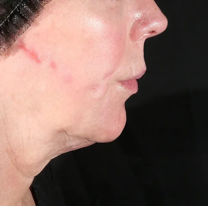 Under the chin, after treatment