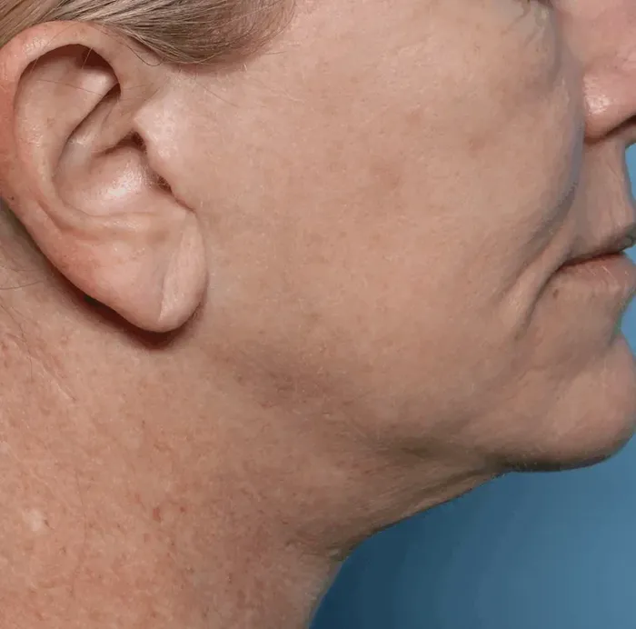 Jawline, before treatment