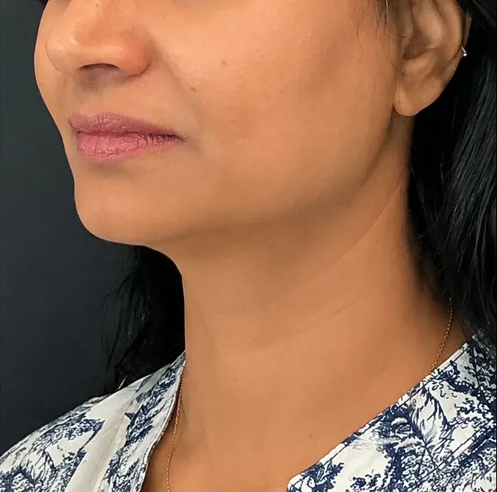 Neck, after treatment