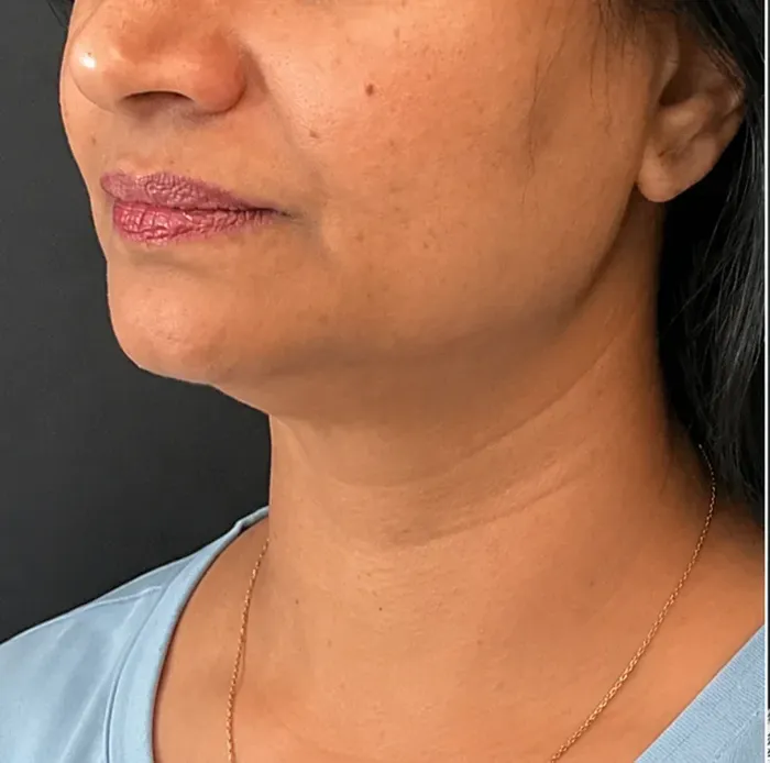 Neck, before treatment