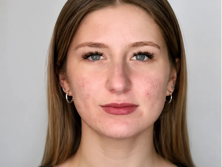 Redness, before treatment